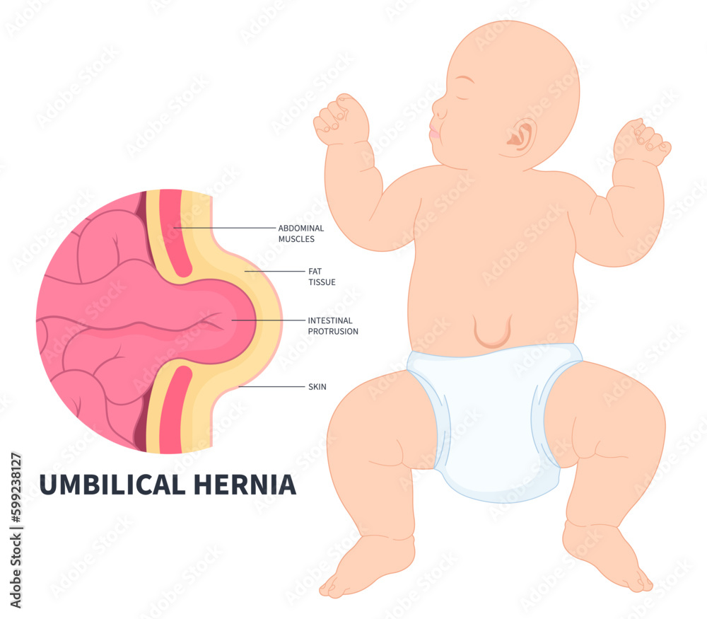 baby infant abdominal stomach pain umbilical hernia of inguinal incisional Femoral diastasis recti volvulus constipation intestine Hiatus birth belly button small large ileus lump navel wall cavity baby infant abdominal stomach pain umbilical hernia of inguinal incisional Femoral diastasis recti volvulus constipation intestine Hiatus birth belly button small large ileus lump navel wall cavity