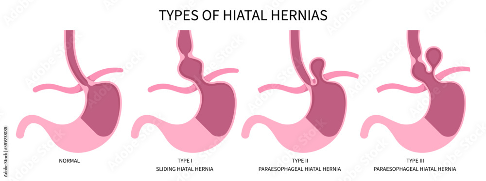 Hiatal Hernia Stomach Disease Heartburn bulges abdomen Nissen ...