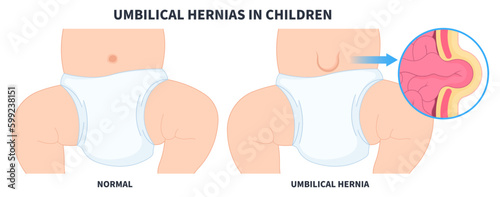 baby infant umbilical hernia of inguinal incisional Femoral stomach pain abdominal diastasis recti volvulus constipation intestine Hiatus birth belly button small large ileus lump navel wall cavity