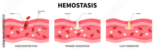 Hemostasis Hemophilia wound healing injury bleeding coagulation blood Fibrin platelet plug Thrombophilia formation fibrinolysis Cascade disorder red cell hemorrhage clot embolisms photo