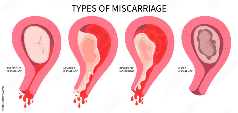 Miscarriage abortion loss pregnancy stillbirth implantation bleeding ectopic Vaginal baby period conception D&C and cervix pain obstetric Gynaecological birth early Cervical Cerclage pregnant - obrazy, fototapety, plakaty 