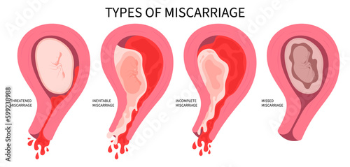 Miscarriage abortion loss pregnancy stillbirth implantation bleeding ectopic Vaginal baby period conception D&C and cervix pain obstetric Gynaecological birth early Cervical Cerclage pregnant photo