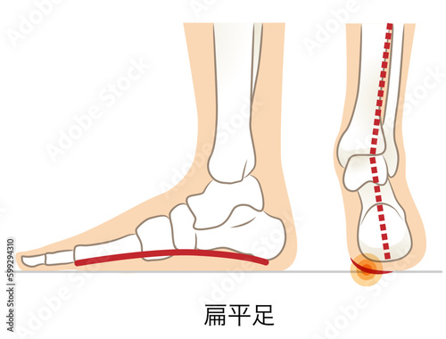 扁平足の側面と後ろ面