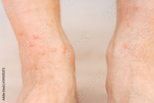 Close up allergic rash dermatitis eczema on man foot. Leg with red rash caused by insect bites. Dermatitis, folliculitis, fungal infection. Affected area of skin to turn red and blotchy and to swell