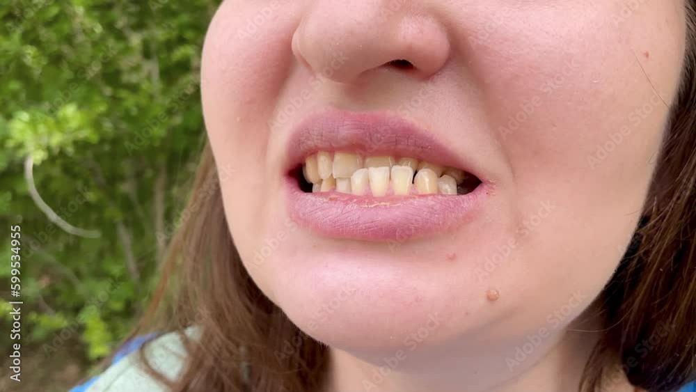 Patient with dislocated jaw and malocclusion, temporomandibular joint