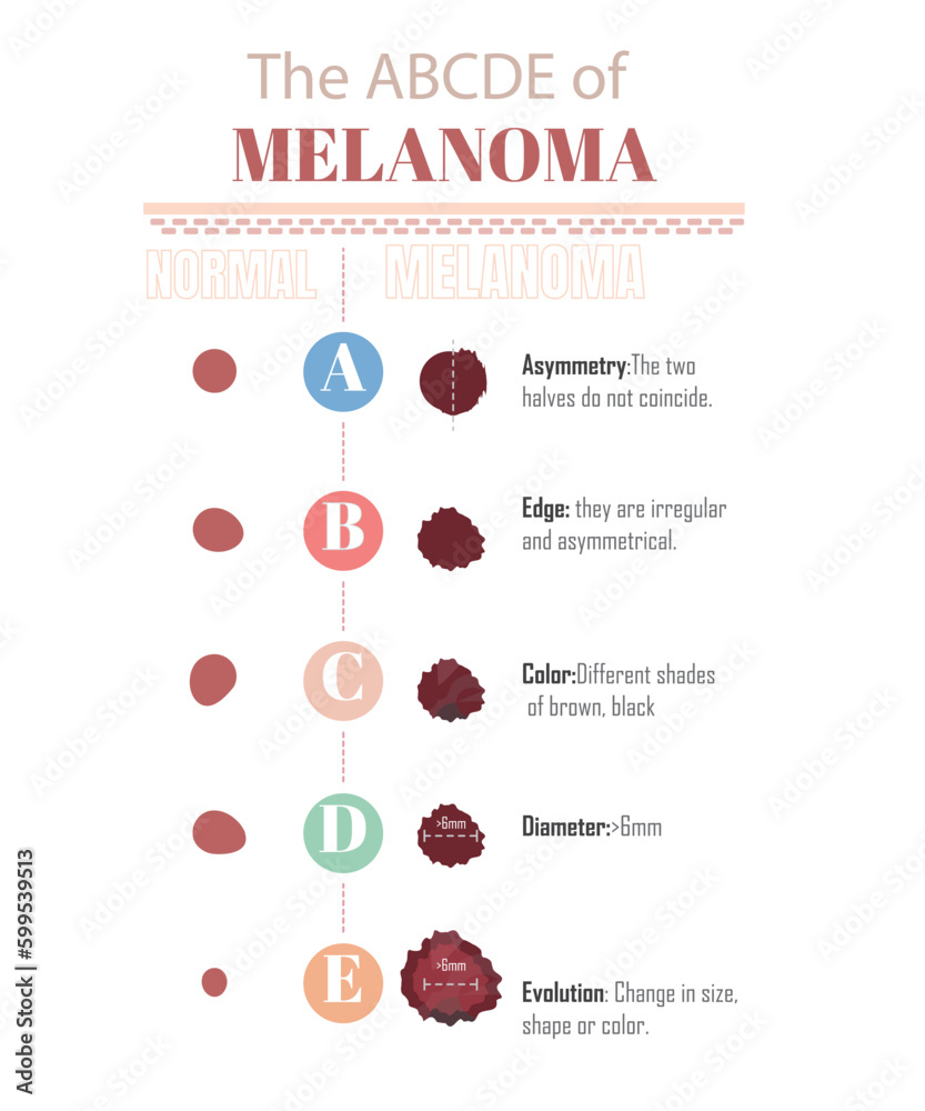 The ABCDE Of Melanoma To Know If You Have A Melanoma On A White Background Stock Vector