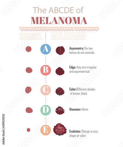 The ABCDE of melanoma, to know if you have a melanoma, on a white background.