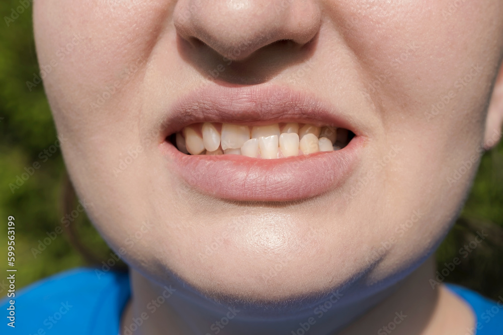 Patient woman with dislocated jaw and malocclusion, temporomandibular