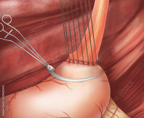 Gastroesophageal anastomosis surgery.This medical illustration shows the anastomosis technique of the remnant stomach and esophagus. photo