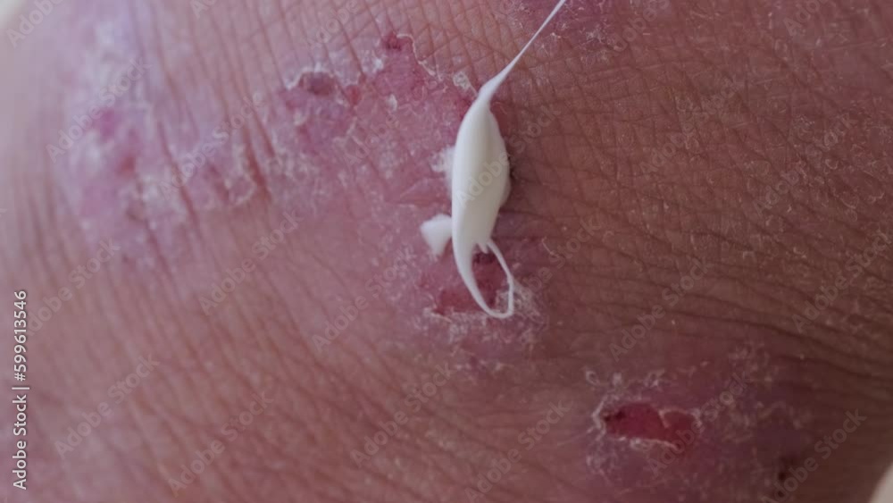 closeup weeping wounds, venous ulcers on female leg, diabetes mellitus