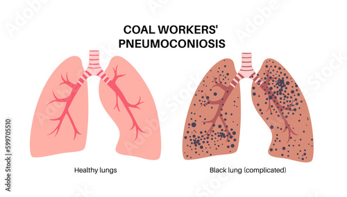 Coal workers disease