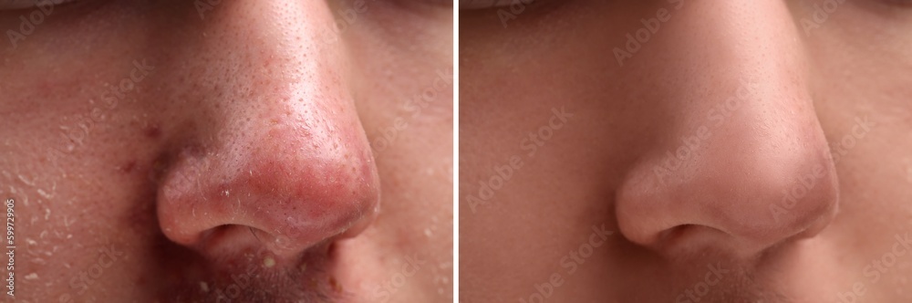Fototapeta premium Photos of man before and after acne treatment, closeup. Collage showing affected and healthy skin
