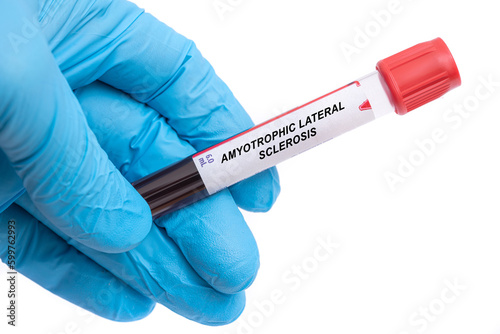 Amyotrophic Lateral Sclerosis. Amyotrophic Lateral Sclerosis disease blood test in doctor hand photo