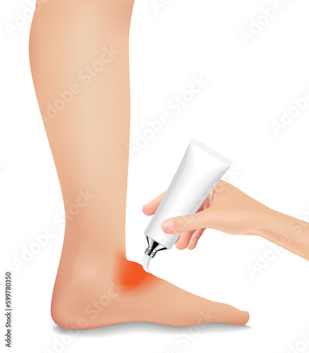 The injured foot is red and swollen like a realristic, treatment with medication. vector illustration.