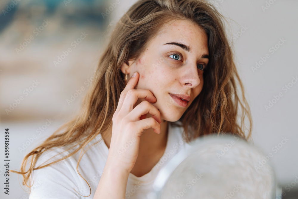 Young woman  with problem skin looking into mirror. Dermatology. Allergic reaction from cosmetic, red spot or rash on face.  Beauty care. 