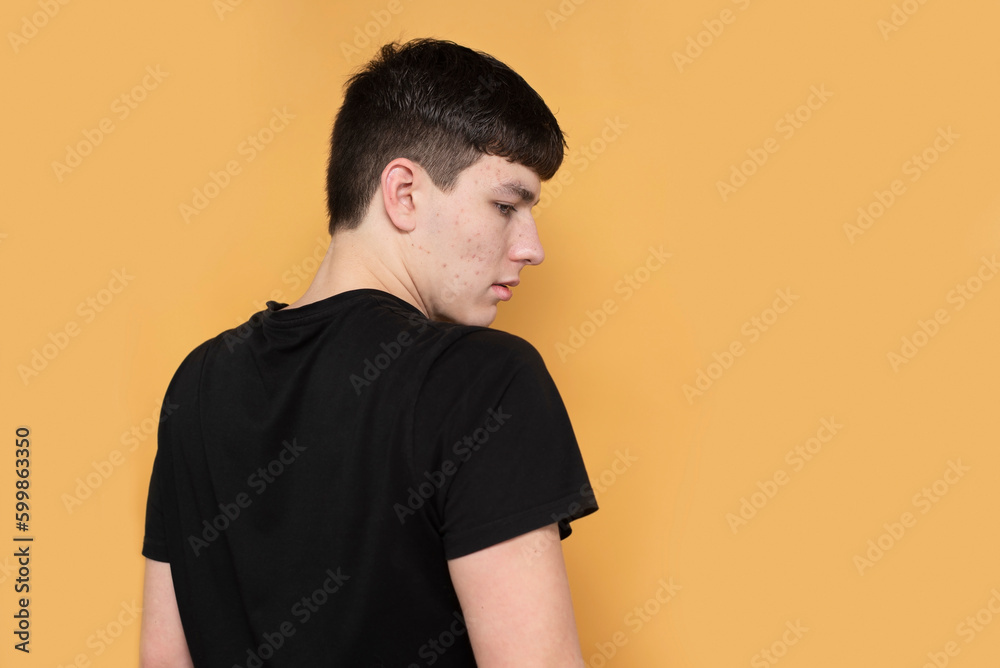 Teenage boy with acne on his face and acne marks, the boy does not want to look at the camera, looks away and is ashamed of his face, he has skin problems Teenage boy with acne on his face and acne marks, the boy does not want to look at the camera, looks away and is ashamed of his face, he has skin problems