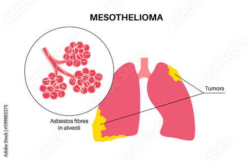 Mesothelioma cancer disease