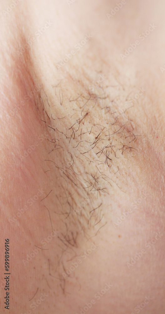Young Woman With Hairy Armpit. Hair Removal