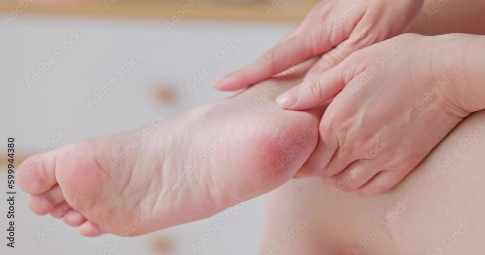 Asian woman touching cracked heels Asian woman touching cracked heels