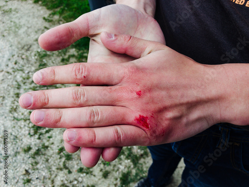 Cracked hands from the cold. Wounds on the climber's hands. © Maniockus