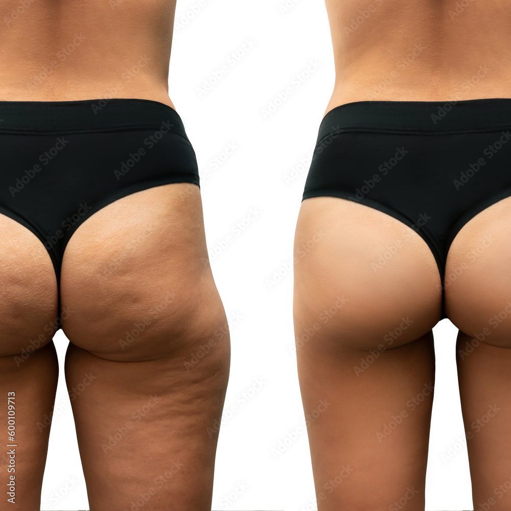 Young woman's thighs and buttocks with cellulite before and after treatment on white background. Getting rid of excess weight. Result of diet, sports, massage. Improving the skin on legs. Comparison - obrazy, fototapety, plakaty 
