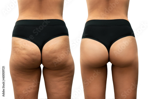Print op canvas Young tanned woman's thighs and buttocks with cellulite before and after treatment on white background