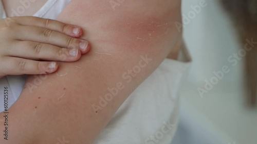 Wallpaper Mural Unrecognizable boy scratches hand with flaky skin, close-up. Irritated, reddened, peeling skin after aggressive exposure to UV rays on sensitive epidermis of child. Problem of excessive sunburn. Torontodigital.ca