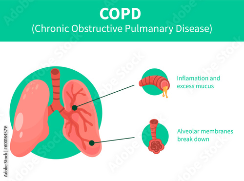 human Lungs vector clip art icon. COPD vector illustration, chronic obstructive pulmonary explanation