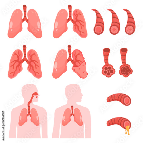 human Lungs vector clip art icon. COPD vector illustration, chronic obstructive pulmonary explanation