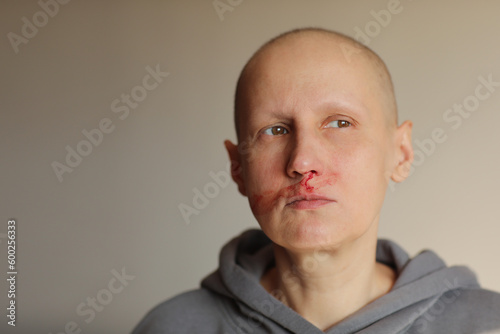 Hairless cancer sick female patient is bleeding from her nose, effects of chemotherapy. Young bald woman lost her eyebrows and eyelashes and has heavy nosebleed with red blood on the face. photo