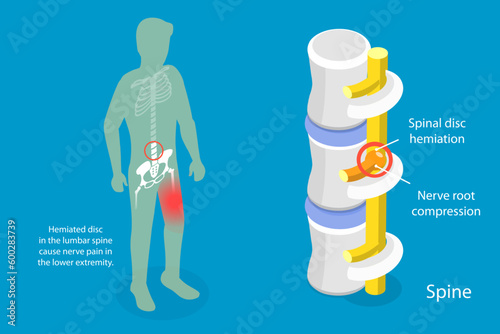 3D Isometric Flat Vector Conceptual Illustration of Sciatica Nerve Pain, Disc Degeneration photo