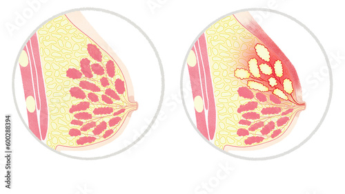 Normal breast and mastitis comparison PNG photo