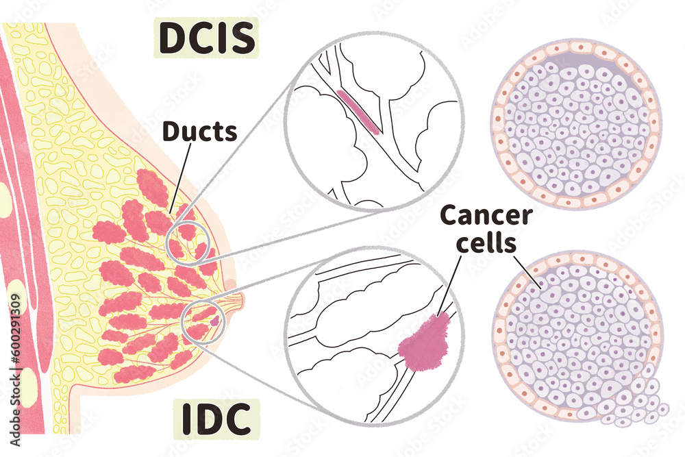Anatomy of female breast cancer DCIS and IDC PNG Stock Illustration