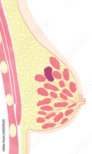 Anatomy of female breast cancer; lobular carcinoma PNG