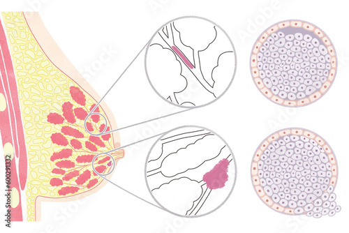 Anatomy of female breast cancer DCIS and IDC; copy space PNG photo