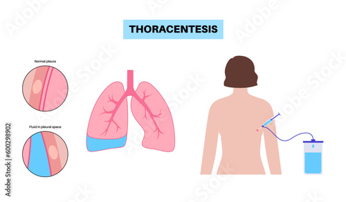 Thoracentesis medical procedure