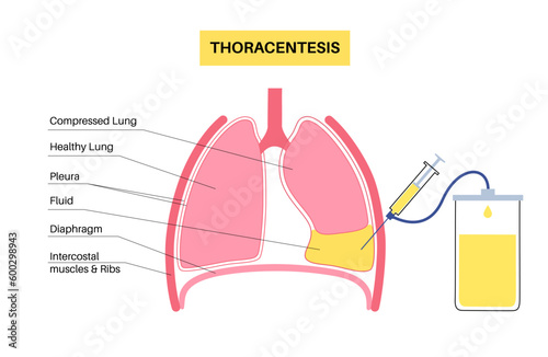 Thoracentesis medical procedure
