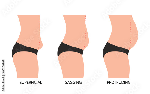 Oerweight. Sagging, protruding and superficial tummy. Types bellies of human body