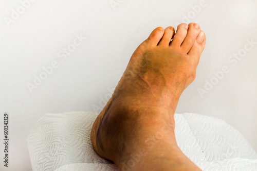 Swollen, edematous and bruised left foot as a result of external sprain,close-up taken photo
