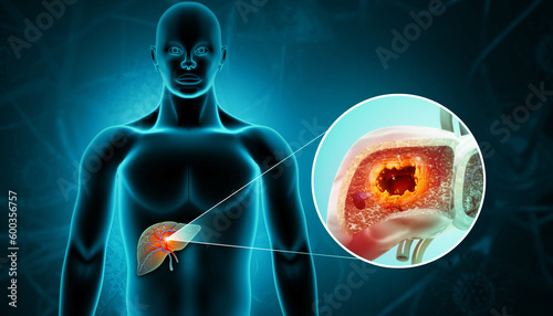 Liver cancer or liver tumor, Hepatocellular carcinoma (HCC), causes, symptoms, treatments, 3d illustration photo