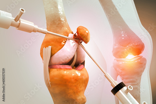 Canvas Print Human knee joint surgery. 3d illustration