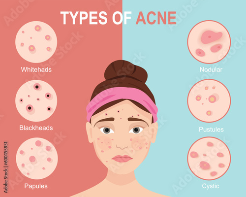 Types of acne. Skin problems