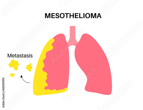Mesothelioma cancer disease