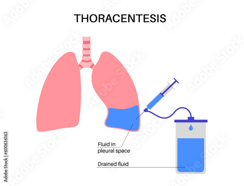 Thoracentesis medical procedure