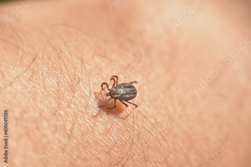 Infected tick on hairy human skin. Ixodes ricinus. Parasitic mite, Encephalitis tick