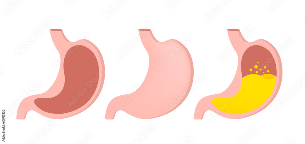 Healthy and unhealthy, empty and full human stomach in trendy flat style. Nutrition, stomach pain, bloating. Digestive system anatomy. isolated on white background. Vector illustration