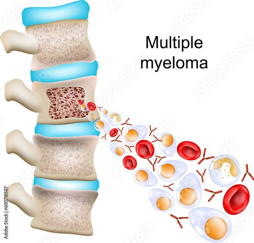 Multiple myeloma