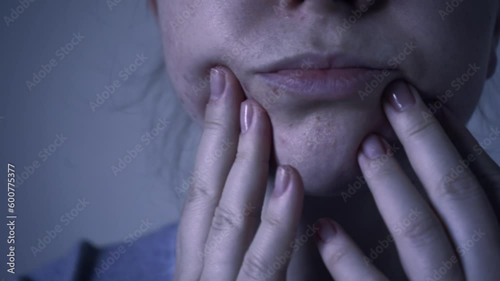 Close up of skin problems, unhealthy skin with acne and pimples. Porous, demodex and rosacea, red rashes. The concept of care for problem skin. Allergic and redness. Close up of skin problems, unhealthy skin with acne and pimples. Porous, demodex and rosacea, red rashes. The concept of care for problem skin. Allergic and redness.