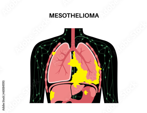 Mesothelioma cancer disease