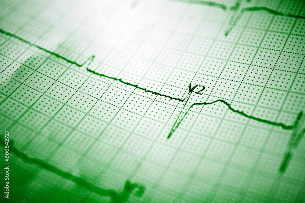 Close-up of an electrocardiogram printed on green paper. Close-up of an electrocardiogram printed on green paper.